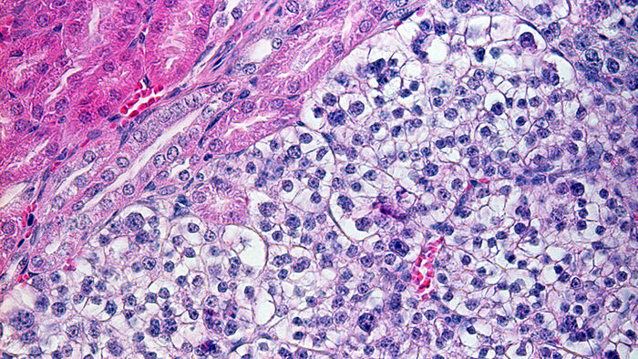 RFP-Human Renal Adenocarcinoma Cells (ACHN)