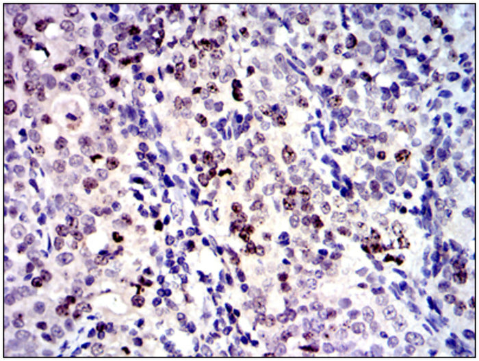 RFP-Human Kidney Carcinoma cells (A498)