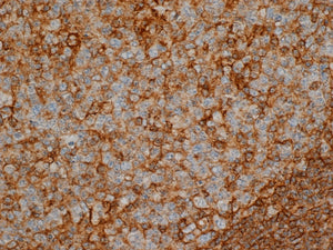 GFP Expressing Human Colorectal Adenocarcinoma (GFP-LS 174T)