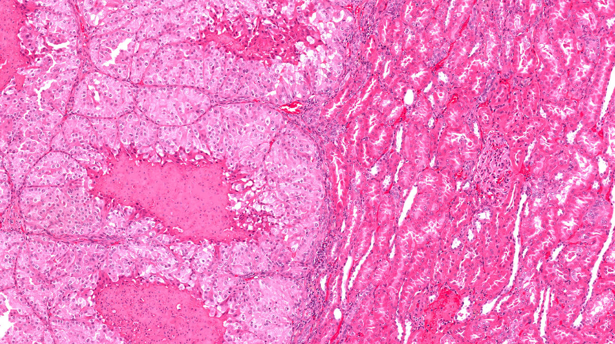 RFP Expressing Human Gastric Carcinoma N87 Cells – UBPONE