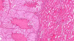 RFP Expressing Human Gastric Carcinoma N87 Cells