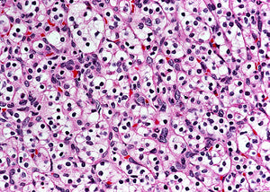 Human MDA-MB-231 (Breast Cancer cells)