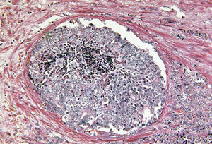 Human Bladder Transitional Carcinoma Cells (SW780)