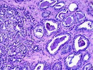 RFP-Human Prostate Carcinoma Cells (DU 145)